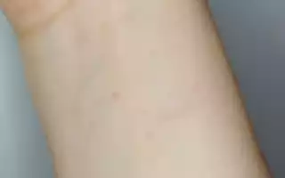 Симптомы и проявления аллергии на спираль