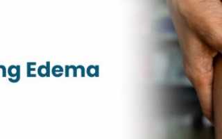 Эдема: определение, причины, симптомы и эффективные методы лечения