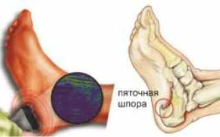Лечение пяточной шпоры ультразвуком, фонофорез с гидрокартизоном