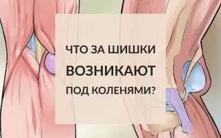 Что делать с шишкой под коленом