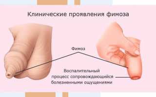 Как избавиться от фимоза у мужчин простыми способами дома