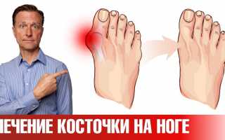 Методы эффективного лечения косточки на большом пальце ноги: рекомендации по упражнениям