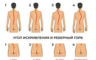 Сколько градусов сколиоза считается допустимым для поступления в военное училище? Узнайте степень сколиоза, при которой вы все еще можете пройти отбор в военное училище.