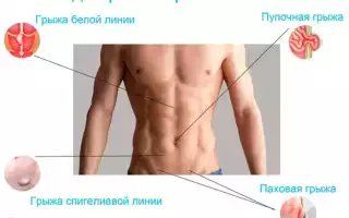 Рекомендации и план питания для диеты при пупочной грыже