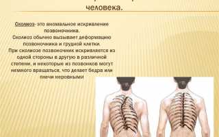 Ограничения и запреты при сколиозе: что стоит избегать для поддержания здоровья позвоночника
