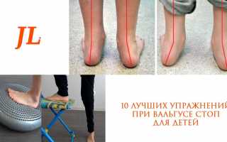 Эффективные упражнения и рекомендации для гимнастики стоп при вальгусной деформации