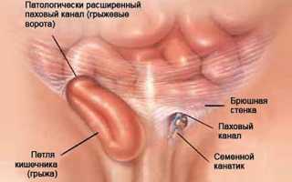 Ключевые симптомы и методы лечения паховой грыжи: понимайте суть!