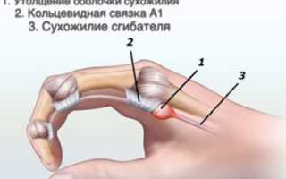 Лигаментит симптомы: причины, диагностика и лечение стеноза лигаментов