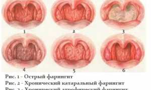 Что такое фарингит и чем он бывает опасен