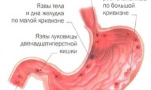 Что такое язва желудка и как она проявляется
