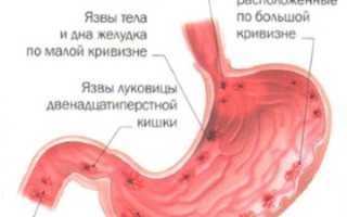 Что такое язва желудка и как она проявляется