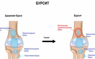 Симптомы, причины и методы лечения супрапателлярной и инфрапателлярной бурсита коленного сустава