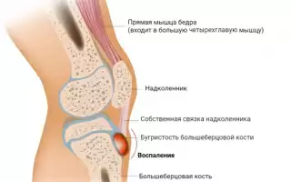 Симптомы, лечение и профилактика болезни Осгуда-Шляттера
