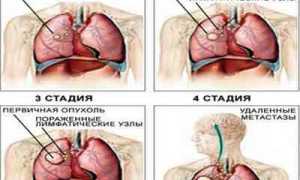 Что такое рак легких и как он проявляется
