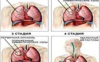 Что такое рак легких и как он проявляется
