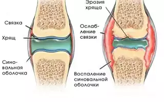 Синовит коленного сустава: причины, симптомы и эффективные методы лечения