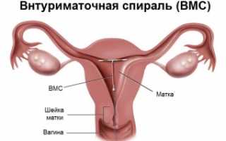 Фото и методы установки внутриматочной спирали – точное расположение в полости матки и способы введения.
