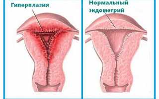 Влияние гиперплазии эндометрия на беременность: причины, последствия и методы лечения
