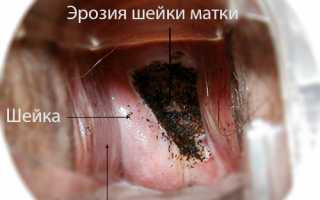 После процедуры прижигания эрозии – последствия и методы реабилитации