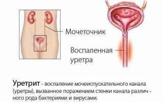 Кандидозный уретрит у женщин и мужчин: симптомы, лечение