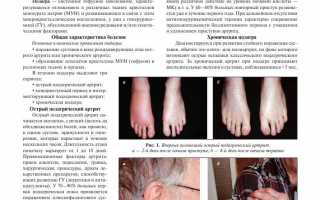 Эффективное лечение женщины с tophaceous формой подагрического артрита: случай из практики.