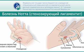 Ноттова болезнь: симптомы, причины и методы лечения