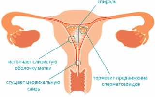 Преимущества и риски использования золотой спирали внутриматочно – все что вы должны знать