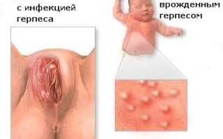 Что приводит к герпесу ануса и как его лечить