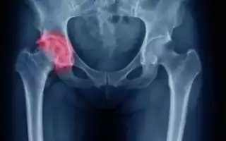 “Подробное описание случая успешного лечения асептического некроза головки бедренной кости с сохранением сустава”.