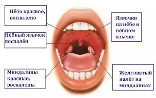 Какие причины, симптомы и лечение герпеса в горле вы должны знать? Информационный портал.