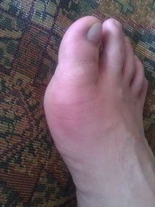 Боль большого пальца Боль в области большого пальца ноги