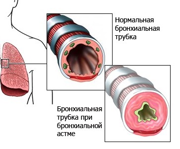 Степени болезни