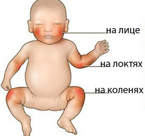 1353519328_allergiya-u-detei-foto