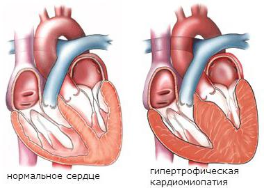 Кардиомиопатия