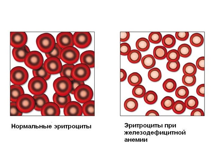 Железодефицитная анемия