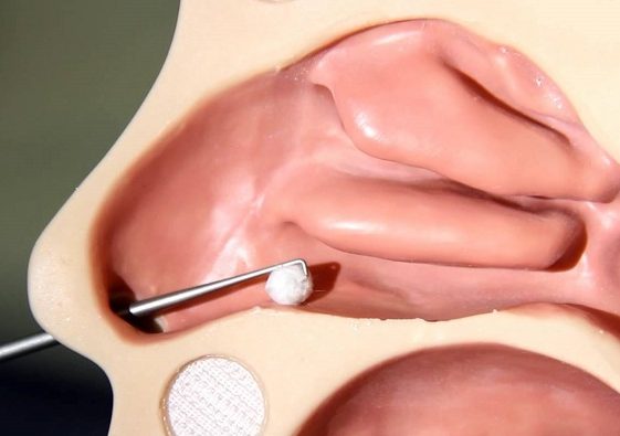 Извлечение инородного тела врачом