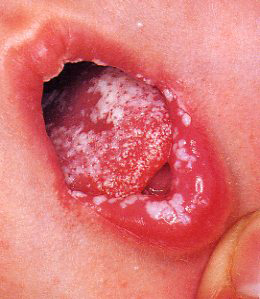 Кандидоз у детей