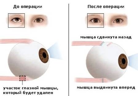 Оперативное лечение