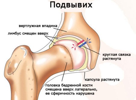 Подвывих головки бедра
