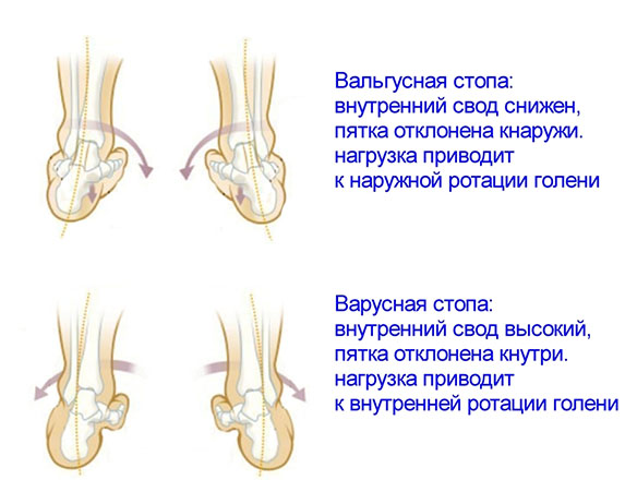 Вальгусная и варусная деформация