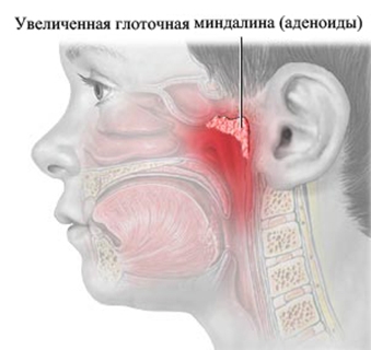 Воспаление аденоидов Воспаление аденоидов
