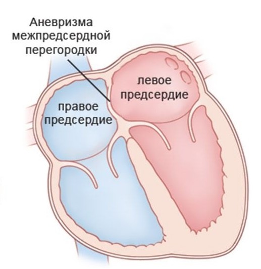 anevrizma-mezhpredserdnoj-peregorodki