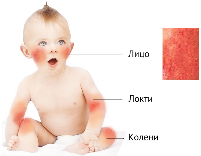 Атомический дерматит