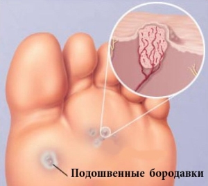Подошвенная бородавка