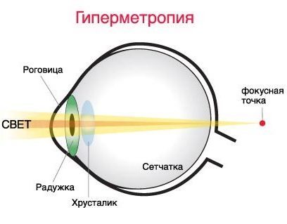Гиперметропия