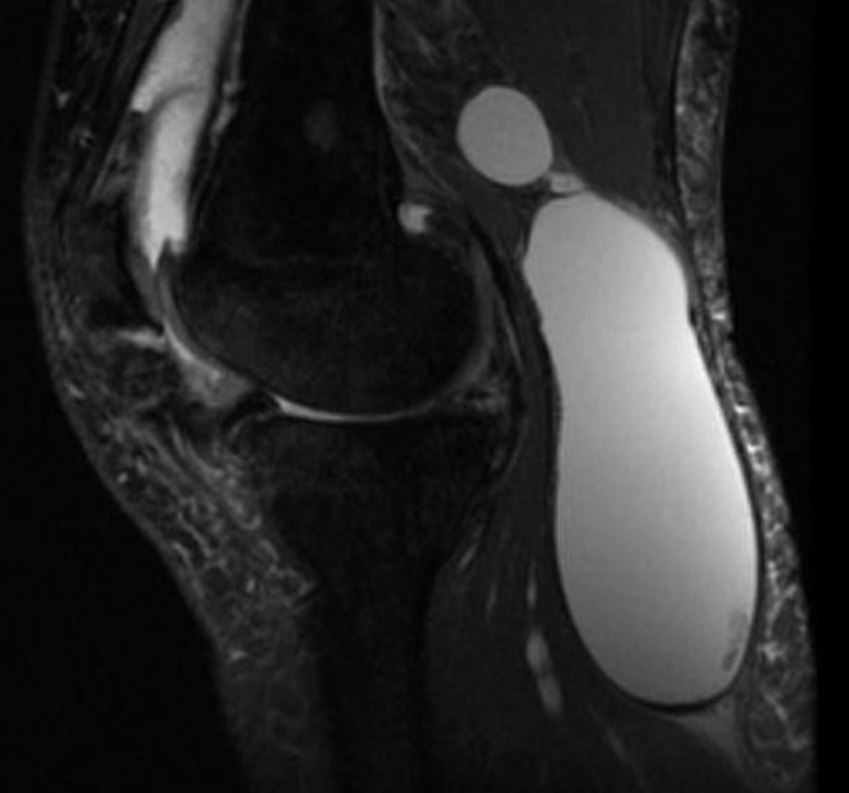 Киста Бейкера на рентгеновском снимке