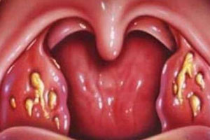 Разновидности ангины и симптоматика