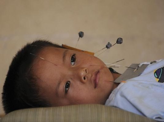 Иглорефлексотерапия