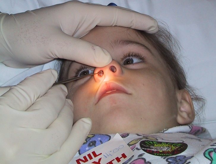 Инородное тело в носу