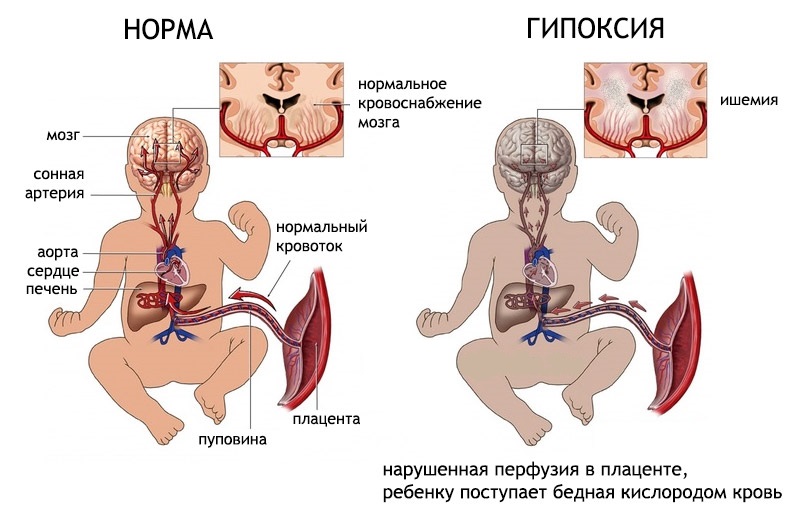 Гипоксия